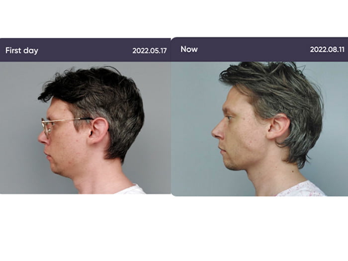 before and after mewing